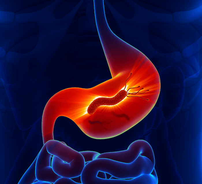 H. pylori infection in the stomach glowing red on dark blue background